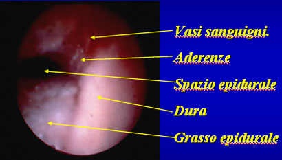 Stenosi5