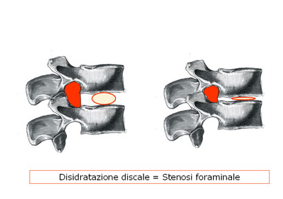 Stenosi3